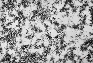 F,50y. | progressive multifocal leukoencephalopathy- viral particles in a glial cell